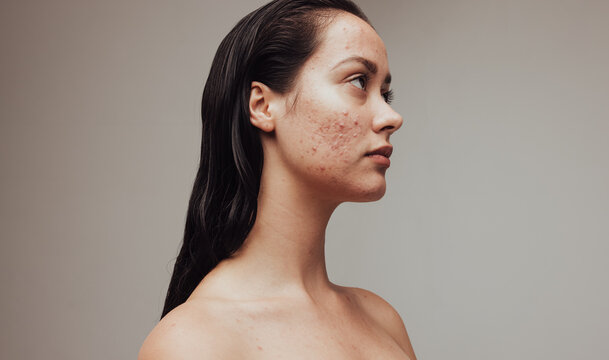 Medical esthetician explaining the different types of acne and acne treatments.