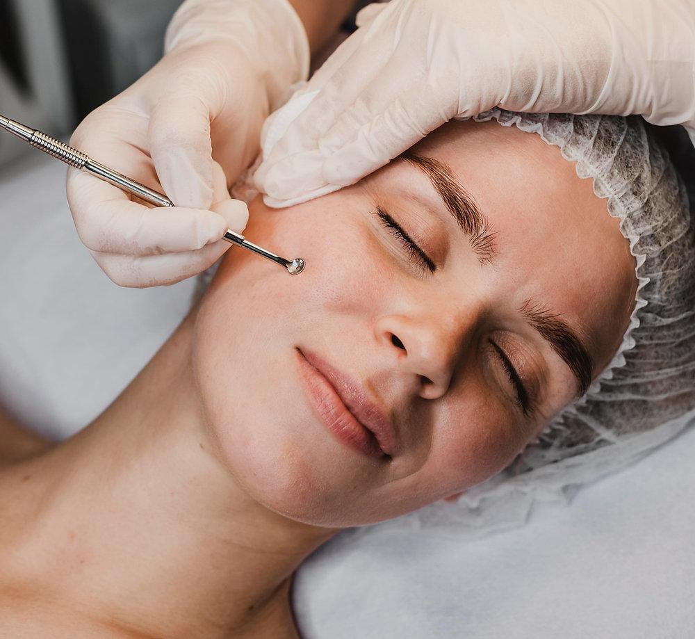 Professional acne facial with extractions for acne-prone skin