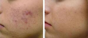 Before and after chemical peel treatment for acne and post-acne discoloration