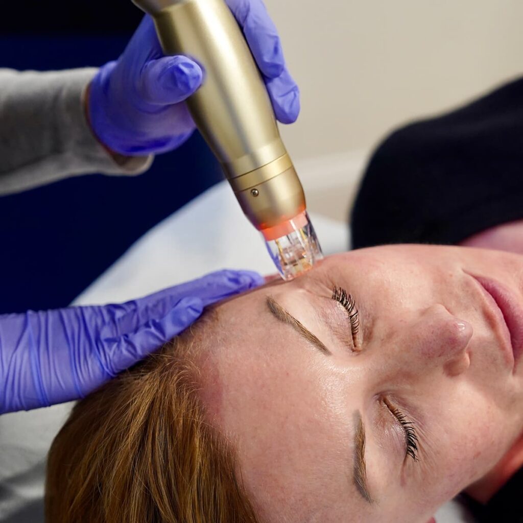 Microneedling for acne scars using Sylfirm X