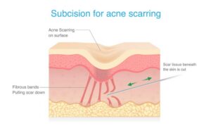 Subcision releasing tethered acne scars beneath the skin