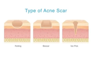 Different types of acne scars including ice pick, boxcar, and rolling scars